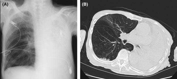 This composite medical image presents a clinical comparison of total left lung collapse using two diagnostic modalities: a frontal chest radiograph (A) and an axial thoracic CT scan (B). In image A, the chest X-ray shows complete opacification of the left hemithorax with a notable absence of air-filled lung markings, indicative of massive atelectasis. The right lung remains well-aerated with visible pulmonary vasculature. Medical hardware, including ECG leads and potentially a nasogastric tube, are visible. In image B, the axial CT scan at the level of the main bronchi confirms complete left-sided atelectasis, appearing as a dense, consolidated mass of soft tissue density occupying the posterior hemithorax. The right lung demonstrates compensatory hyperinflation. A key diagnostic feature shown in the CT is the obstruction of the left main bronchus by high-density foreign material (aspirated enteral formula), leading to distal resorption atelectasis. This visual set is essential for teaching the radiographic signs of obstructive lobar/total lung collapse and the clinical complications associated with pulmonary aspiration in patients receiving enteral nutrition.