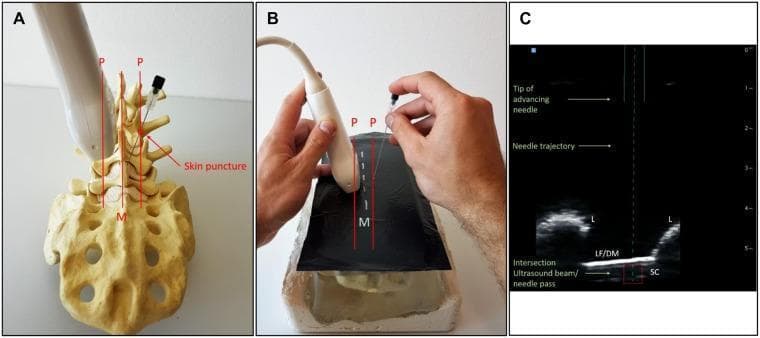This composite educational graphic illustrates a real-time ultrasound-guided spinal puncture procedure using a paramedian sagittal oblique (PSO) approach.
Panel A shows an anatomical model of the lumbar spine and sacrum, demonstrating the transducer and needle placement at the paramedian (P) markers, roughly 1 cm lateral to the midline (M) with medial angulation. Panel B depicts the clinical setup on a phantom model, showing hand placement for the needle-guidance system.
Panel C is a paramedian sagittal ultrasound scan used for needle tracking. Key anatomical landmarks include the hyperechoic laminae (L) with acoustic shadowing, the ligamentum flavum/dura mater complex (LF/DM) appearing as a bright linear structure, and the underlying spinal canal (SC). The display features an augmented reality overlay: a dotted line representing the predicted needle trajectory and a solid line indicating the actual advancing needle. A red square designates the target intersection where the needle is expected to enter the spinal canal between adjacent laminae. This illustrates a neuraxial anesthesia or lumbar puncture technique optimized for medical training and procedural accuracy.
