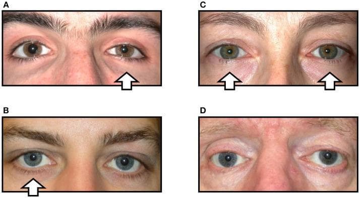A clinical comparison chart consisting of four color photographs (A-D) demonstrating variations in oculosympathetic paresis (Horner syndrome) signs. (A) Displays classic unilateral Horner syndrome of the right eye, characterized by mild upper eyelid ptosis, elevation of the lower eyelid (reverse ptosis), miosis (pupillary constriction), and mild conjunctival injection. (B) Shows 'incomplete' Horner syndrome with right-sided miosis but absence of visible ptosis. (C) Illustrates bilateral Horner syndrome, where symmetry in pupil size and lid position masks the pathology due to lack of a normal comparative side. (D) Demonstrates 'Pseudo-Horner syndrome' in the right eye; lid asymmetry, enophthalmos, and hypoglobus are present due to a prior orbital floor fracture rather than sympathetic denervation, accompanied by physiological anisocoria. White arrows indicate the affected side(s) in each case. This comparison teaches the importance of distinguishing true sympathetic paresis from structural orbital pathology and identifying partial or bilateral presentations.