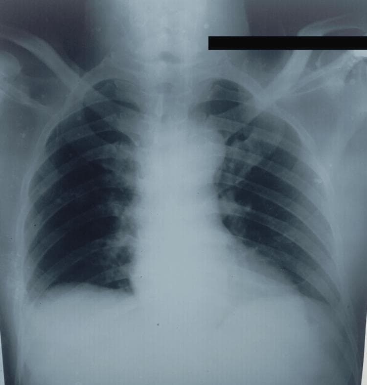 This diagnostic image is an anteroposterior (AP) chest X-ray of a human patient, used to screen for pulmonary involvement in a case of extrapulmonary tuberculosis. The radiographic findings are largely unremarkable, showing clear lung fields bilaterally without evidence of active infiltrates, cavitary lesions, or pleural effusions. The cardiac silhouette is within normal limits in size, and the mediastinum is not widened. The bony structures, including the ribs, clavicles, and visualized thoracic vertebrae, appear intact without fractures or destructive lesions. The costophrenic angles are sharp, and the diaphragmatic contours are well-defined. This visual serves as a clinical comparison to rule out secondary pulmonary tuberculosis in patients diagnosed with isolated esophageal tuberculosis.