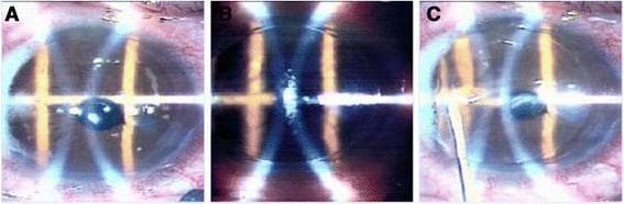 This sequence of three surgical microscopic images (A-C) demonstrates the stages of Laser-Assisted In Situ Keratomileusis (LASIK) on a pseudophakic eye to correct residual refractive error. Panel A shows the initial stage of corneal flap creation using a femtosecond laser; an intraocular lens (IOL) is clearly visible in the posterior chamber through the pupil, indicating prior cataract surgery. Panel B depicts the surgical field after the corneal flap has been elevated, exposing the underlying stromal bed to receive excimer laser ablation for tissue reshaping. Bright reflections in the center of the stromal bed indicate the active laser application zone. Panel C illustrates the final operative phase, where the corneal flap has been repositioned. A micro-cannula is visible performing interface irrigation to remove debris and ensure proper flap adherence. This comparison series serves as an educational tool for ophthalmology trainees regarding refractive enhancement techniques in patients with existing intraocular implants.