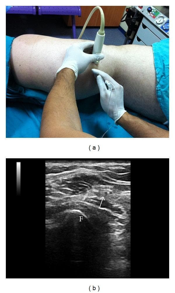 This composite educational image demonstrates the technique for an ultrasound-guided peripheral nerve block of the common peroneal nerve. Image (a) is a clinical photograph showing the transverse placement of a linear ultrasound probe on the lateral aspect of the lower extremity, specifically at the level of the fibular head. The patient is in a supine position with the leg stabilized by a clinician. Image (b) is a corresponding transverse (short-axis) sonogram of the anatomical region. Key landmarks include the hyperechoic cortical surface of the fibula (labeled 'F') with characteristic posterior acoustic shadowing. Superficial and lateral to the fibula, the common peroneal nerve is identified (indicated by the white arrow) appearing as a small, relatively hypoechoic oval structure with a subtle fascicular 'honeycomb' internal pattern. The surrounding musculature and subcutaneous tissues show varying echogenicity. This visual guide is intended for anesthesia and pain management training, highlighting the anatomical relationship between the fibular head and the common peroneal nerve to facilitate safe needle placement during regional anesthesia.