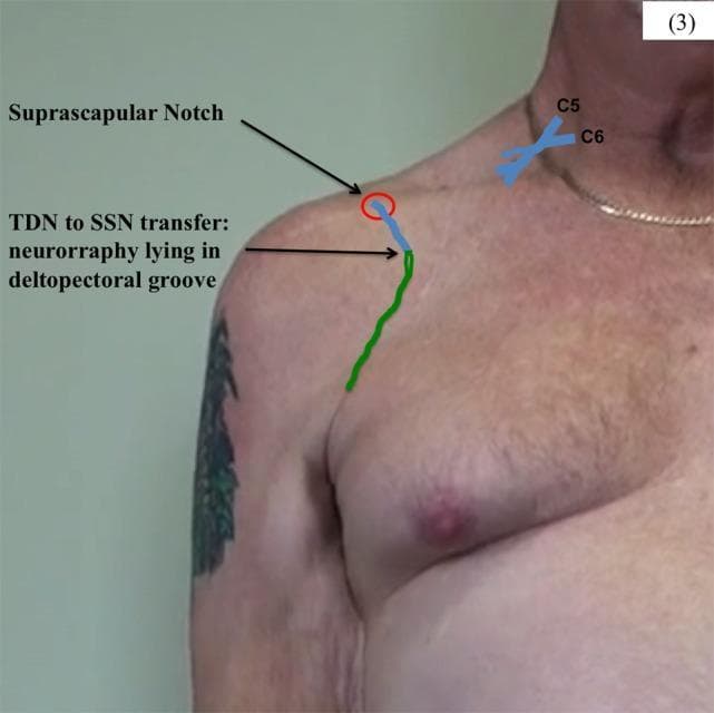 Anatomical Diagram and Clinical Overlay: This image depicts a surgical planning or post-operative schematic for a nerve transfer procedure on the right shoulder of a male patient. The visual combines a clinical photograph with color-coded overlays to illustrate the thoracodorsal nerve (TDN) to suprascapular nerve (SSN) transfer. Key anatomical landmarks are identified, including the cervical roots (C5 and C6) in the neck region and the suprascapular notch near the superior border of the scapula. A green line traces the distal path of the TDN terminal branches as they are mobilized superiorly from the axillary/lateral thoracic region toward the shoulder. A blue line represents the SSN, originating from the brachial plexus and traveling under the clavicle. The point of neurorrhaphy (nerve repair) is indicated where the green and blue lines meet within the deltopectoral groove, just inferior to the suprascapular notch. This diagram demonstrates the surgical management of an upper brachial plexus injury by utilizing a functional motor nerve donor (TDN) to reinnervate the target muscles of the suprascapular nerve.