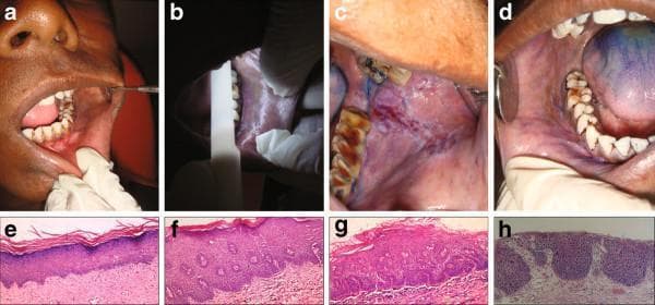 This composite educational graphic details clinical and histopathological diagnostic screening protocols for oral dysplastic lesions. Panels A-D demonstrate clinical examination techniques: (A) conventional visual inspection under incandescent light showing a suspicious oral mucosa lesion; (B) chemiluminescent illumination (430-580nm) where positive lesions appear blue-white/acetowhite; (C) application of toluidine blue showing dark royal blue retention; and (D) a combined diagnostic protocol. Panels E-H present H&E stained photomicrographs (10x magnification) representing the histopathological grading scale for epithelial dysplasia: (E) No dysplasia, showing regular epithelial architecture and lack of atypia; (F) Mild dysplasia, with cellular atypia and architectural changes limited to the lower third of the epithelium and superficial keratosis; (G) Moderate dysplasia, where architectural changes extend into the middle third of the epithelial layer; and (H) Severe dysplasia, characterized by full-thickness architectural disturbances and marked cellular atypia. This visual resource illustrates the correlation between clinical screening adjunctive tools and gold-standard histopathological classification in oral oncology.