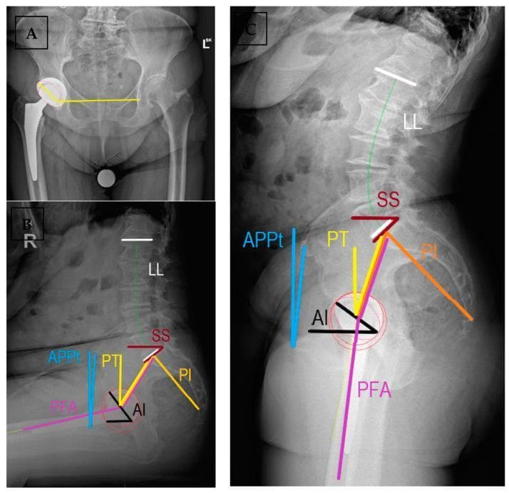 A composite of three X-ray radiographs demonstrating the assessment of spinopelvic parameters and total hip replacement (THR) implant positioning. (A) Anteroposterior (AP) coronal radiograph of the pelvis showing a right-sided total hip arthroplasty. Yellow annotation lines indicate the measurement of acetabular cup inclination and anteversion relative to the transischial line. (B) and (C) are sagittal radiographs showing the lumbosacral spine and pelvis in sitting and standing positions, respectively. These images are annotated with surgical planning software lines (SurgiMap) to measure dynamic parameters: Lumbar Lordosis (LL), Sacral Slope (SS), Pelvic Incidence (PI), Spinopelvic Tilt (PT), Anterior Pelvic Plane Tilt (APPt), Pelvic Femoral Angle (PFA), and Acetabular Anteinclination (AI). The comparison illustrates how the lumbar spine flattens and the pelvis rotates posteriorly when moving from a standing to a sitting position, which is critical for evaluating risk factors like prosthetic impingement or dislocation in orthopedic follow-up.