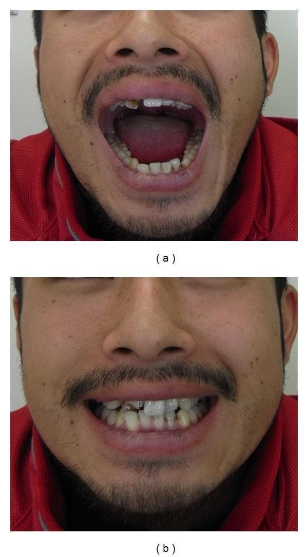 Two-panel clinical intraoral photograph demonstrating postoperative results of mandibular condylar fracture repair. Panel (a) shows the patient with maximal mouth opening, illustrating functional range of motion and a slight lateral deviation of the jaw towards the affected side. The oral cavity reveals irregularities in the maxillary dentition, including missing or damaged anterior teeth and some discoloration. Panel (b) shows the patient in a state of dental occlusion, demonstrating a stable occlusal relationship despite the underlying dental wear and malalignment. The images are used to evaluate functional recovery, specifically the restoration of masticatory function and joint mobility following surgical reduction and internal fixation of a condylar process fracture. The medical specialty is Oral and Maxillofacial Surgery, focusing on the assessment of jaw mechanics and occlusal stability in the recovery phase.