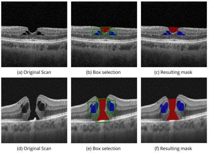 This diagnostic image provides a series of cross-sectional B-scans obtained through Optical Coherence Tomography (OCT) of the human macula, demonstrating the segmentation of vitreoretinal pathology. The panel displays two separate clinical cases of macular holes (MH) across three stages of automated analysis: (a, d) original scans, (b, e) box selection modality, and (c, f) final segmented masks.
