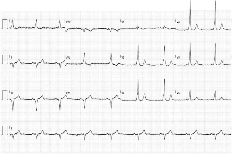 A 12-lead baseline electrocardiogram (ECG) demonstrating classic features of ventricular pre-excitation, characteristic of Wolff-Parkinson-White (WPW) syndrome. The tracing shows a short PR interval and widened QRS complexes across multiple leads. A prominent delta wave (slurring of the initial QRS portion) is visible, most notably in leads I, aVL, and the precordial leads V2-V6. The QRS morphology, specifically the negative delta waves in the inferior leads (II, III, and aVF), suggests a posteroseptal location for the accessory pathway. Secondary repolarization abnormalities are present, including ST-segment depression in the lateral precordial leads (V3-V6), which can occur as a result of altered ventricular activation rather than primary ischemia. The rhythm is sinus, and the overall tracing serves as an educational example of how accessory pathways modify cardiac conduction and QRS morphology.