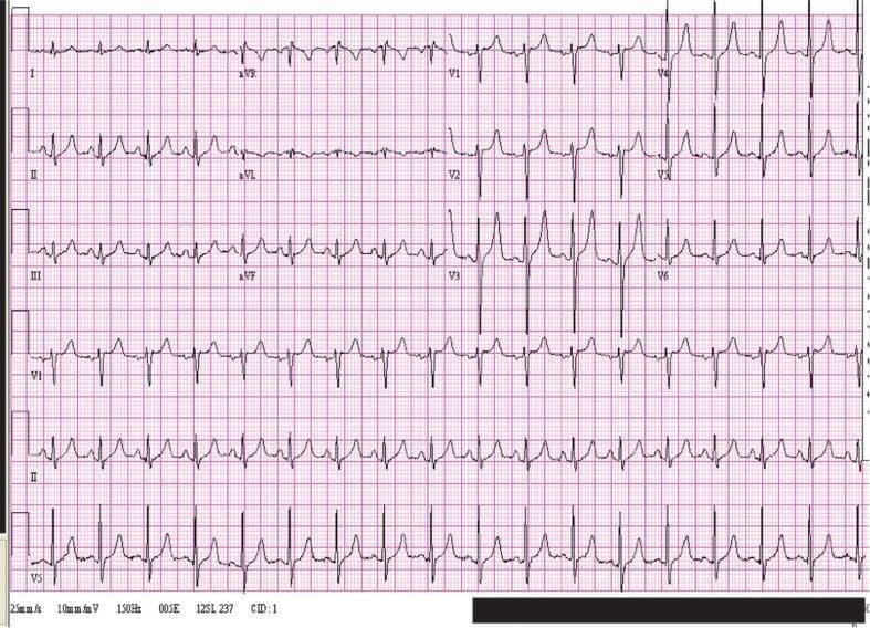 A standard 12-lead electrocardiogram (ECG) demonstrating findings characteristic of moderate hyperkalemia. The diagnostic tracing shows all standard leads (I, II, III, aVR, aVL, aVF) and precordial leads (V1-V6). Key findings include prominent, symmetrical, peaked T waves most evident in the precordial leads V2 through V4, though they appear less extreme than in severe hyperkalemia cases. The QRS complexes are relatively narrow, approximately 80 msec in duration, following clinical intervention for an elevated potassium level (noted as 5.9 mEq/L). The rhythm appears sinus, though P-wave amplitude may be subtly diminished. This diagnostic image serves as an educational example of the dynamic evolution of ECG changes during the treatment of electrolyte imbalances, specifically showing the narrowing of the QRS complex and the residual prominence of T waves as hyperkalemia begins to resolve.