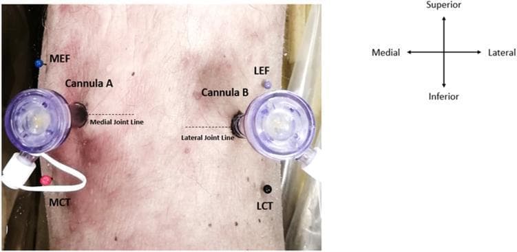 Clinical photograph and anatomical diagram showcasing the surgical portal placement in a posterior left knee cadaveric specimen. The image illustrates the positioning of two arthroscopic twist-in cannulas (labeled Cannula A and Cannula B) inserted into the direct posterior portals. Cannula A is situated along the medial joint line, while Cannula B is positioned along the lateral joint line. Key bony landmarks are identified with colored pins for surgical reference: the medial epicondyle of the femur (MEF), the medial condyle of the tibia (MCT), the lateral epicondyle of the femur (LEF), and the lateral condyle of the tibia (LCT). An orientation compass is included to define superior, inferior, medial, and lateral axes. This visual serves as an educational guide for orthopedic surgical training, specifically for establishing safe zones and avoiding neurovascular structures during posterior knee arthroscopy.