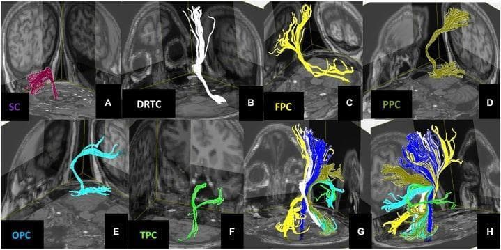 This diagnostic image displays 3D Diffusion Tensor Imaging (DTI) tractography reconstructions of human cerebellar pathways, overlaid on anatomical MRI slices. Panels A through F demonstrate individual pathways: (A) Spinocerebellar (SC) in magenta, originating in the medulla/spinal cord and entering the cerebellum via the inferior cerebellar peduncle; (B) Dentate-Rubro-Thalamo-Cortical (DRTC) in white, showing the efferent path from the dentate nucleus to the thalamus and cortex; (C) Fronto-Ponto-Cerebellar (FPC) in yellow; (D) Parieto-Ponto-Cerebellar (PPC) in mustard-yellow; (E) Occipito-Ponto-Cerebellar (OPC) in cyan; and (F) Temporo-Ponto-Cerebellar (TPC) in green. Panels G and H provide composite views, including the Corticospinal Tract (CST) in dark blue, illustrating the spatial relationship and integration of feed-forward and feed-backward cerebrocerebellar loops. The visual content highlights the distinct cortical termination points—frontal, parietal, occipital, and temporal lobes—essential for understanding the cerebellum's role in motor coordination, sensory integration, and higher cognitive functions. This visualization serves as an educational resource for neuroanatomy and clinical neurology.