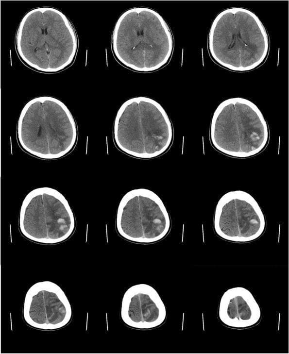A series of twelve non-contrast axial CT scan slices of the brain demonstrating a large acute cerebral infarction with hemorrhagic transformation. The images reveal a significant area of hypodensity involving the left subcortical region and the corona radiata, consistent with cytotoxic edema and tissue death from an ischemic stroke. Within this hypodense zone, multiple focal areas of hyperdensity are visible, indicating acute intraparenchymal hemorrhage. According to the European Cooperative Acute Stroke Study (ECASS) classification, this appearance is characteristic of parenchymal hematoma type 2 (PH2), where the hemorrhage occupies more than 30% of the infarcted area and exerts a mild mass effect. Key anatomical landmarks include the lateral ventricles and cortical sulci, with the latter showing some effacement on the left side due to associated swelling. This diagnostic imaging serves as a classic educational example of secondary hemorrhagic transformation following a primary ischemic event.