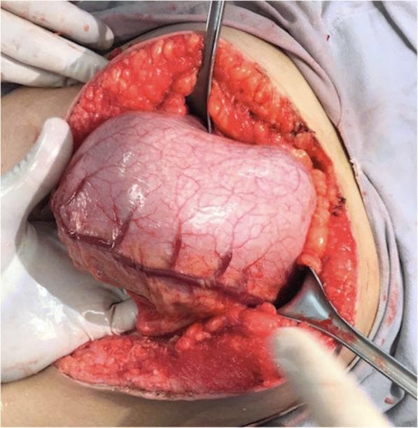 This clinical photograph captures an intraoperative view of an exploratory laparotomy, focusing on the anterior wall of the stomach. The organ is significantly distended, protruding through the abdominal incision. A hallmark feature shown is the prominent congestion and dilation of the gastroepiploic arteries across the serosal surface, indicating increased pressure or vascular compromise within the gastric chamber. Surgical retractors are positioned to maintain exposure of the operative field, revealing the subcutaneous adipose tissue and the underlying abdominal musculature. In the clinical context of the patient's presentation, this gastric distention is secondary to a large trichobezoar. The image serves as a teaching tool for recognizing macroscopic signs of gastric outlet obstruction and the surgical anatomy of the upper gastrointestinal tract during a gastrotomy procedure. It is relevant for medical students and surgical residents studying abdominal pathology, specifically bezoars and intestinal intussusception.