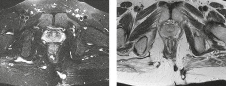 This diagnostic imaging set consists of axial MRI scans of the pelvic region focusing on the perianal area, utilizing T2-weighted Fat Suppressed (left) and T2-weighted turbo spin-echo (right) sequences. The images demonstrate an intersphincteric perianal fistula with a characteristic horseshoe-shaped configuration. The fistulous tract exhibits high signal intensity (hyperintense) on the T2-weighted sequences, effectively contrasting against the low signal intensity of the surrounding anal sphincter muscles. This tract is located within the intersphincteric space, bounded by the internal and external anal sphincters. The primary opening is visualized on the left posterior aspect of the anal canal. The high-signal area suggests active inflammation or fluid collection within the tract. Key anatomical structures visible include the rectum, levator ani muscle, and the ischioanal fossa. These images are clinically significant for the classification of perianal fistulae according to the Parks or St James's University Hospital classification systems, assisting in surgical planning by defining the relationship between the inflammatory tract and the sphincteric complex.