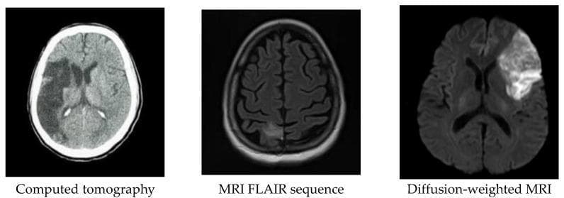 A comparison of diagnostic neuroimaging modalities showing acute ischemic stroke in axial brain slices. The first image is a non-contrast Computed Tomography (CT) scan displaying a large, wedge-shaped area of hypodensity in the right hemisphere, consistent with a Middle Cerebral Artery (MCA) territory infarct and associated cytotoxic edema. The second image is an MRI Fluid Attenuated Inversion Recovery (FLAIR) sequence, which demonstrates the infarct as a region of hyperintensity (bright signal) against the dark, signal-suppressed cerebrospinal fluid (CSF). The third image is a Diffusion-Weighted Imaging (DWI) MRI, showcasing the same pathology as a prominent hyperintense region. This bright signal on DWI indicates restricted water diffusion, which is a hallmark of acute cerebral ischemia. The panel illustrates how different imaging sequences enhance the contrast between normal and infarcted neural tissue, facilitating early stroke identification and localization.
