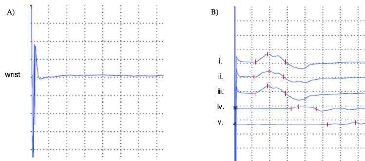This diagnostic image displays a nerve conduction study (NCS) of the right ulnar nerve, divided into sensory (A) and motor (B) components. Panel A shows the sensory nerve action potential (SNAP) recording at the wrist, characterized by a stimulus artifact followed by a flat baseline, indicating a lack of sensory response. Panel B illustrates motor nerve conduction tracings (CMAP) from five stimulation points: (i-iii) wrist, (iv) below the elbow, and (v) above the elbow. The motor tracings reveal significant pathology: traces i-iii show reduced distal amplitudes and prolonged distal latency, while traces iv and v demonstrate severe attenuation of the waveform and marked slowing of conduction velocity. This pattern of partial conduction block and reduced amplitude across the elbow is diagnostic of severe cubital tunnel syndrome or ulnar neuropathy at the elbow with mixed axonal and demyelinating features. Red vertical hash marks indicate latency and peak markers used for quantitative analysis in clinical neurophysiology.