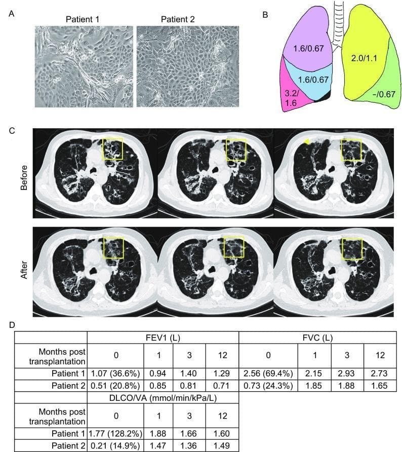 This composite educational image illustrates an autologous SOX9+ basal cell (BC) transplantation study for bronchiectasis.
Panel A displays phase-contrast microscopy of cultured SOX9+ BCs from two patients, showing distinct morphologies: Patient 1 exhibits elongated, spindle-like shapes with visible intercellular spaces, while Patient 2 shows a dense, confluent epithelial-like monolayer.
Panel B is an anatomical diagram of the lungs, color-coded by lobe, indicating the cell dosage (×10^7) delivered per lobe for each patient.
Panel C presents consecutive axial high-resolution computed tomography (HRCT) scans of Patient 2 before and one year after transplantation. Yellow squares highlight a region of severe bronchiectasis; the 'After' images demonstrate regional recovery, characterized by a reduction in cystic dilation and decreased bronchial wall thickening.
Panel D contains data tables tracking pulmonary function (FEV1, FVC, and DLCO/VA) from baseline to 12 months post-transplantation. These clinical findings collectively suggest that SOX9+ BC transplantation may facilitate structural and functional repair of damaged airway tissue in chronic obstructive lung disease.