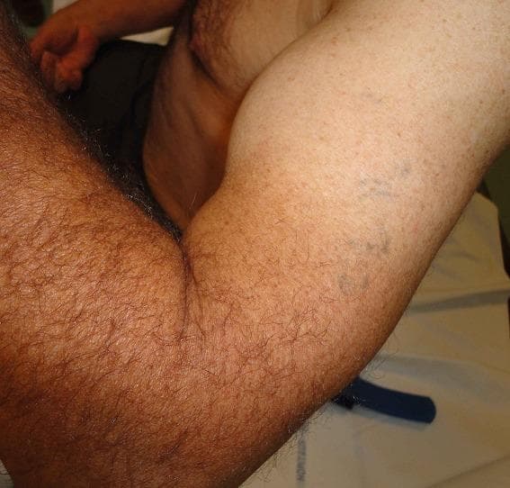This clinical photograph displays a lateral view of a flexed left upper extremity, demonstrating a classic 'Popeye deformity' or 'Popeye sign.' The visual finding consists of a prominent, rounded, and distal bulge of the biceps brachii muscle belly, which has retracted toward the mid-to-distal humerus. This characteristic contour abnormality is pathognomonic for a rupture of the biceps tendon (proximal or distal, though in this context distal is specified). Associated findings include visible ecchymosis and bruising on the medial aspect of the arm, indicating acute soft tissue trauma and hematoma formation. The deformity is highlighted by the elbow being held in a flexed position, which accentuates the muscular bunching. This image is a primary educational resource for orthopedic physical examination findings in musculoskeletal injuries, specifically for medical students and residents learning to identify tendon ruptures through visual inspection and surface anatomy.