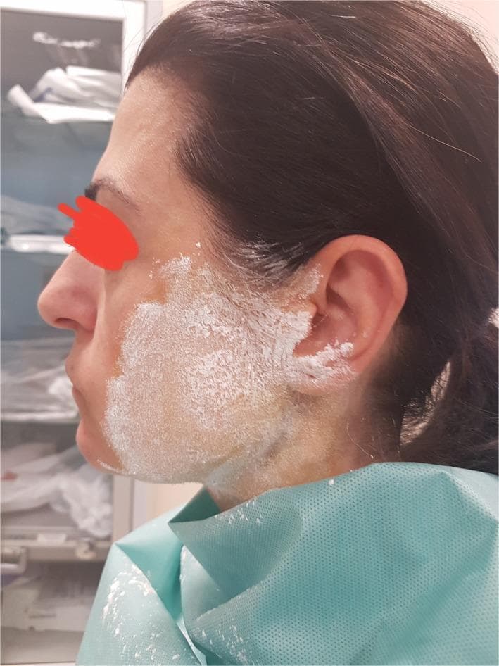 Clinical photograph of a patient undergoing the Minor starch-iodine test, a diagnostic tool for evaluating localized hyperhidrosis or Frey syndrome. The image shows the lateral profile of a patient's face with a thick, white layer of starch powder applied over a dried iodine solution on the right cheek, preauricular region, and extending toward the mandibular angle. The starch appears as a matte, powdery coating with variations in density at the peripheral margins near the ear and temple. This setup is used to visualize abnormal gustatory sweating; when sweat is produced, the chemical reaction between iodine and starch in the presence of moisture results in a characteristic blue-black or violet discoloration. The patient is draped in a medical-grade blue protective gown. Anonymization is maintained via a digital red marking over the eye. The clinical significance of this procedure is to map the specific area of autonomic dysfunction for targeted treatment, such as botulinum toxin injections.