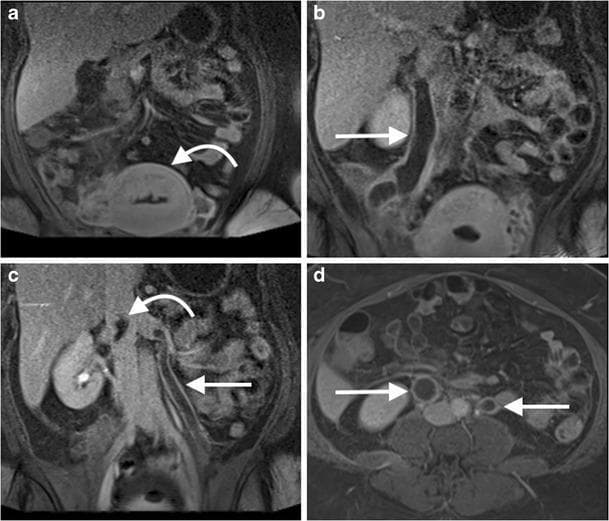 This diagnostic imaging panel consists of coronal (a-c) and axial (d) images from a post-contrast venous phase fat-saturated T1-weighted MR venogram of the abdomen. The case illustrates bilateral ovarian (gonadal) vein thrombosis in a 35-year-old post-partum patient following dilatation and curettage. Image (a) identifies the post-partum uterus (curved arrow). Images (b) and (c) demonstrate marked dilatation of the right and left gonadal veins (straight arrows) with prominent central filling defects, indicating intraluminal thrombus. In image (c), a curved arrow highlights the superior extension of the thrombus reaching the juxtarenal inferior vena cava (IVC). The axial image (d) provides a cross-sectional view of the expanded gonadal veins bilaterally, clearly showing the low-signal intensity central thrombi surrounded by peripheral contrast enhancement (straight arrows). This study demonstrates a rare but serious post-partum complication involving extensive pelvic venous thrombosis and its pathway toward the central venous system.