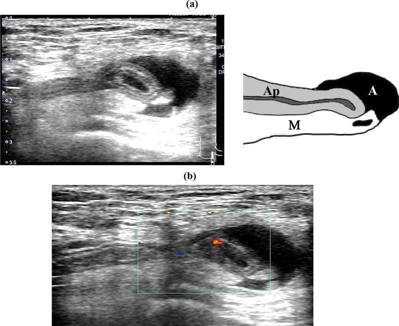 This composite educational resource features diagnostic ultrasound imaging and a corresponding schematic diagram of a de Garengeot hernia. Image (a) is a grayscale B-mode ultrasound showing a longitudinal view of the right inguinal region. It demonstrates a blind-ended tubular structure (the appendix, labeled 'Ap') protruding through the femoral canal. The appendix exhibits a preserved five-layered wall structure and a hyperechoic lumen, measuring approximately 4 mm at the body and 6 mm at the tip. Surrounding the appendix is a reticular hyperechoic area representing the mesoappendix ('M') and an adjacent anechoic region indicative of local ascites ('A'). Image (b) utilizes Color Doppler imaging to show pulsatile blood flow signals within the appendiceal wall, represented by red and blue color pixels. This finding confirms tissue viability and the absence of vascular compromise or strangulation within the hernia sac. A depth scale on the left provides a spatial reference up to 3.5 cm. These images serve as a key diagnostic reference for identifying an incarcerated but non-inflamed appendix within a femoral hernia.