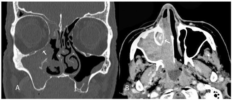 This diagnostic image displays two computed tomography (CT) scans of the paranasal sinuses demonstrating a carcinoma of the maxillary sinus and lateral nasal cavity wall. Panel A is a coronal (frontal) plane CT in a bone window, showing a soft tissue mass occupying the right maxillary sinus and nasal cavity. An arrow highlights focal bone erosion of the inferior orbital wall (orbital floor), indicating tumor extension beyond the sinus boundaries. Panel B is an axial plane CT showing the same soft tissue mass invading the right nasolacrimal duct region, marked by an arrow. The normally air-filled or clear anatomy is replaced by an infiltrative density, suggesting aggressive local progression typical of squamous cell carcinoma or similar sinonasal malignancies. These findings are clinically significant for surgical planning, such as medial maxillectomy, and for assessing the risk of postoperative complications like nasolacrimal duct stenosis.