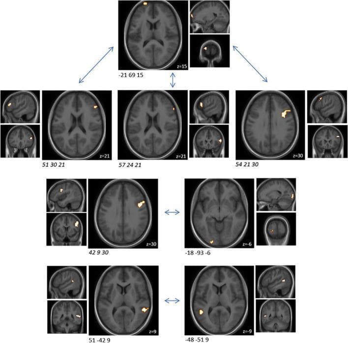 This diagnostic image displays functional Magnetic Resonance Imaging (fMRI) results superimposed on standard axial, sagittal, and coronal anatomical scans. The figure illustrates multi-planar views of several neural clusters exhibiting significant functional connectivity changes (FDR-corrected p < 0.05) between placebo and probiotic intervention groups during an emotional attention task (EAT). Each panel presents a primary large axial slice (labeled with z-coordinates such as z=15, z=21, z=30) accompanied by smaller sagittal and coronal localized views to characterize the 3D spatial extent of the clusters. Bright orange-to-yellow clusters highlight specific areas of altered activity, including regions in the frontal cortex, parietal lobes, and occipital areas (as indicated by the peak MNI coordinates x, y, z provided below each set). Double-headed arrows indicate functional connectivity relationships or comparisons between specific clusters. This visual data is used in neuroscience and psychiatric research to study the gut-brain axis, demonstrating how probiotic interventions can modulate connectivity within predefined brain networks and the Brainnetome atlas (BNA).