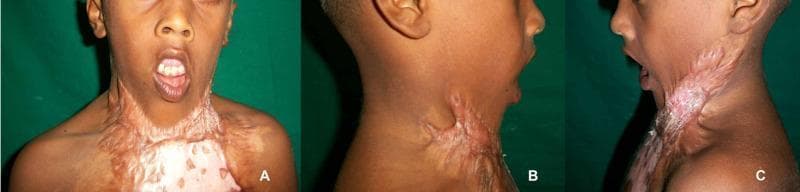 This composite clinical photograph series (A, B, C) demonstrates severe post-burn neck contracture in a pediatric patient. Frontal and lateral views reveal extensive hypertrophic scar tissue involving the anterior neck and extending inferiorly to the chest wall and superiorly toward the clavicles. The scar presents as a dense, irregular, and raised band of tissue with mixed hyper- and hypopigmentation. Key clinical findings include severe obliteration of the cervicomental angle (B), a permanent 'bowed down' head posture indicative of significant restriction in neck extension and flexion (C), and lower lip incompetence characterized by traction-induced ectropion where the lip is pulled inferiorly away from the gingiva (A). These visual features are consistent with Onah type 3c severe anterior neck contracture, illustrating the functional and aesthetic morbidity associated with unmanaged thermal injury, including restricted range of motion and facial secondary deformities.