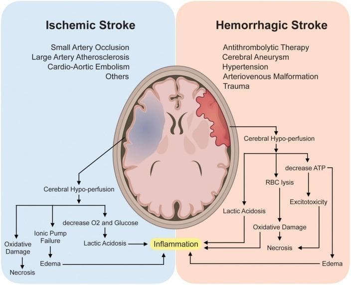 This medical infographic and pathophysiology flowchart compare Ischemic and Hemorrhagic stroke mechanisms. At the top, two axial brain illustrations highlight affected regions: a blue-shaded area in the left hemisphere represents ischemia, while a red-shaded area in the right hemisphere represents hemorrhage. Listed etiologies for Ischemic Stroke include small artery occlusion, large artery atherosclerosis, and cardio-aortic embolism. Hemorrhagic causes include antithrombolytic therapy, aneurysm, hypertension, arteriovenous malformation, and trauma. Below the illustrations, a logic flow depicts both conditions leading to cerebral hypo-perfusion. The ischemic pathway outlines oxygen/glucose deprivation, ionic pump failure, and lactic acidosis. The hemorrhagic pathway highlights red blood cell (RBC) lysis and ATP depletion. Both pathways converge on common secondary brain injury mechanisms: neuroinflammation, excitotoxicity, oxidative damage, and cerebral edema, all of which terminate in neuronal necrosis. This diagram serves as an educational tool for neurology students to understand the diverging initiating events and converging molecular outcomes of different stroke types.