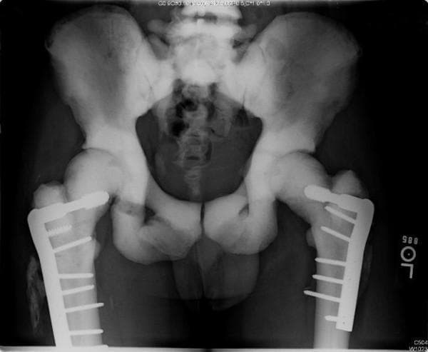 Anteroposterior (AP) radiograph of the pelvis and bilateral proximal femurs demonstrating characteristic features of osteopetrosis, including generalized increased bone density (sclerosis) and the 'bone-within-a-bone' (endostoma) appearance. The radiograph shows bilateral subtrochanteric femur fractures managed with orthopedic internal fixation. On both sides, lateral locking plates are secured with multiple cortical screws; the hardware remains intact without signs of loosening or failure. On the right side (anatomical right), the subtrochanteric fracture line appears attenuated and poorly defined, indicating chronic healing progression. Adjacent to the right proximal femur, there is evidence of mature heterotopic ossification. The left-sided fracture site shows a higher degree of healing with no clearly visible residual fracture lines. The iliac wings and sacrum exhibit significant opacification, and the visualized lumbar vertebrae demonstrate 'sandwich vertebrae' end-plate thickening typical of marble bone disease.