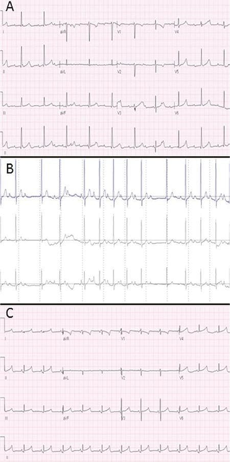 A comparison of three sequential electrocardiographic (ECG) tracings demonstrating the evolution and resolution of atrioventricular (AV) conduction abnormalities. Panel A displays a standard 12-lead ECG from Day 1 showing complete AV dissociation (Third-degree AV block). Key findings include a regular atrial rate (P waves) significantly faster than the regular ventricular rate (narrow QRS complexes), indicating no relationship between atrial and ventricular activity. Panel B presents a rhythm strip from a 24-hour Holter monitor on Day 15, illustrating a Mobitz Type I (Wenckebach) AV block. The tracing shows characteristic progressive prolongation of the PR interval followed by a non-conducted P wave (dropped QRS complex). Panel C shows a follow-up 12-lead ECG from sixteen months later, demonstrating a normal sinus rhythm with stable 1:1 AV conduction, consistent P wave morphology, and a normal PR interval. This visual progression is used to educate on the clinical spectrum of congenital heart block and its potential for recovery.