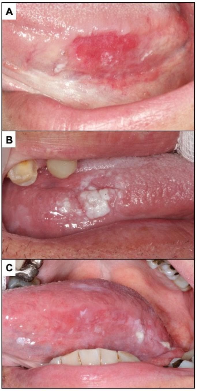 This composite of three clinical photographs (A, B, C) illustrates diverse clinical presentations of oral potentially malignant disorders and oral squamous cell carcinoma on the lateral border of the tongue. Panel (A) depicts erythroplasia, manifesting as a well-defined, intensely erythematous macule with an irregular, slightly granular surface texture and peripheral white striae. Panel (B) shows oral carcinoma presenting with a leukoplakia-like appearance, characterized by a thick, heterogeneous white plaque that is raised and irregular, contrasting sharply with the adjacent pink mucosa. Panel (C) demonstrates oral carcinoma with a mixed erythroleukoplakic appearance, featuring a combination of erythematous (red) and leukoplakic (white) components across the lateral tongue surface. These images serve as educational examples of incipient and established oral malignancies, highlighting the diagnostic importance of identifying persistent red, white, or mixed lesions in high-risk anatomical sites like the lateral tongue. The variations in color, texture, and border demarcation represent different clinical phenotypes within the spectrum of oral cancer development.