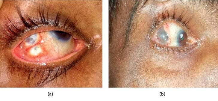 This comparison clinical photograph depicts a case of anterior nodular scleritis of the right eye before and after treatment. Image (a) shows the eye in an acute inflammatory state, characterized by significant scleral and conjunctival injection (redness) and the presence of multiple, well-defined, yellowish-white elevated nodules located on the temporal sclera. Engorged episcleral blood vessels are clearly visible. Image (b) shows the same eye after two months of antitubercular therapy (ATT) and highly active antiretroviral therapy (HAART). The photograph demonstrates a marked clinical improvement, with a significant reduction in inflammation and conjunctival hyperaemia. The previously prominent nodules have largely regressed, leaving behind slight scleral thinning and residual grayish discoloration, indicative of healing and resolution of the granulomatous process. This visual comparison illustrates the efficacy of targeted systemic therapy in treating infectious nodular scleritis associated with tuberculosis and HIV coinfection.