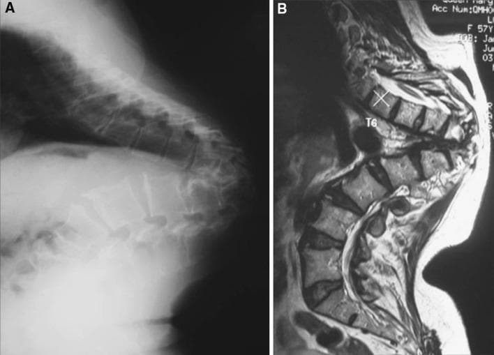 This composite educational graphic features two lateral diagnostic images of the thoracic spine illustrating late-onset Pott's paraplegia in healed disease. Image A is a lateral plain film X-ray showing severe, sharp-angled thoracic kyphosis (gibbus deformity). There is evidence of significant vertebral body destruction and anterior wedging at the lower thoracic level, leading to collapse and a prominent sagittal deformity. Image B is a sagittal T2-weighted MRI scan of the same patient. The MRI demonstrates the acute angulation of the spinal column and the proximity of the spinal cord to the apex of the internal kyphus. Notably, the vertebral bodies show uniform marrow signal intensity with no evidence of marrow edema, soft tissue abscesses, or gadolinium enhancement, which indicates that the underlying tuberculous infection is healed and inactive. The educational focus is on distinguishing structural mechanical complications (kyphosis causing cord kinking) from active spinal tuberculosis (Pott's disease).