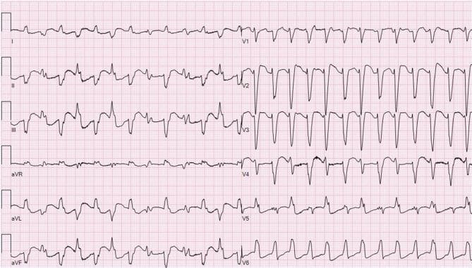 A 12-lead electrocardiogram (ECG) demonstrating a broad complex tachycardia with distinct morphological variations across the leads. In the limb leads (I, II, III, aVR, aVL, aVF) and some precordial leads (V1, V5, V6), the rhythm appears irregularly irregular with narrow to slightly widened QRS complexes and absent P waves, consistent with atrial fibrillation and possible aberrant conduction. However, in leads V2, V3, and V4, the tracing transitions into a regular, wide-complex rhythm characterized by bizarre, sharply peaked, and uniform QRS complexes with a rapid steep descent. The morphology in these specific leads is suggestive of bidirectional ventricular tachycardia or a ventricular origin. This visual comparison illustrates the transition between a supraventricular arrhythmia (atrial fibrillation) and a more organized wide-complex ventricular rhythm, potentially related to digoxin toxicity or cardiac electrophysiological instability. The educational focus is on rhythm recognition, QRS morphology analysis, and the identification of potentially life-threatening ventricular arrhythmias.