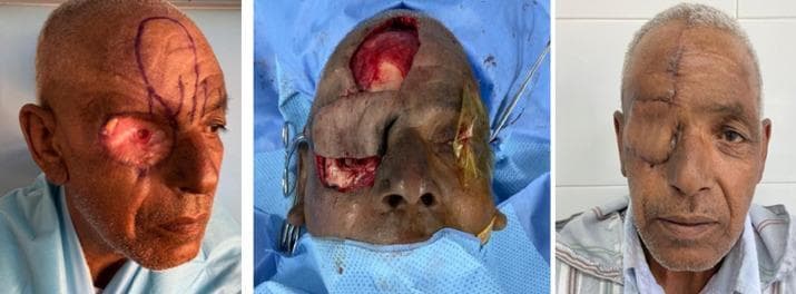 A series of three clinical photographs documenting the stages of orbital exenteration cavity reconstruction using a pedicled paramedian forehead flap. The left image (pre-operative/initial stage) shows a total right orbital exenteration defect with erythematous granulation tissue and surgical ink markings on the forehead delineating the donor flap based on the supratrochlear artery. The center image (intra-operative) illustrates the surgical transposition of the skin flap, which has been rotated 180 degrees to cover the orbital defect, leaving a secondary donor site on the upper forehead. The right image (post-operative) shows the final result at 4 months, demonstrating a well-healed reconstruction with the flap completely obliterating the orbital cavity. There is a visible midline vertical scar on the forehead and peripheral sutures where the flap was integrated into the facial skin. The texture and color of the flap are consistent with the surrounding facial tissue, indicating successful graft take and aesthetic integration.