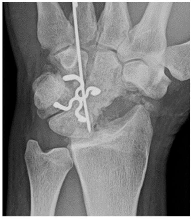 This posteroanterior (PA) X-ray of the wrist demonstrates a four-corner fusion (arthrodesis), a surgical procedure typically used to treat advanced carpal collapse or arthritis (e.g., SNAC or SLAC wrist). The scaphoid bone is absent, consistent with a total scaphoidectomy. The remaining four carpal bones—the lunate, capitate, hamate, and triquetrum—are consolidated into a single unit. Surgical hardware is central to the image, featuring multi-pronged zig-zag shaped surgical staples that traverse the intercarpal joints to promote bony fusion through compression. Additionally, a vertical Kirschner wire (K-wire) is visible, providing temporary longitudinal stabilization and alignment through the capitate and lunate toward the distal radius. The distal radius and ulna are intact, showing clear joint spaces at the radiocarpal interface despite the midcarpal fusion. This visual serves as a primary example of limb-salvage orthopaedic surgery aimed at preserving limited wrist motion while alleviating pain from degenerative carpal instability.