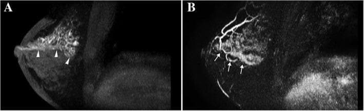 This diagnostic imaging composite displays breast Magnetic Resonance Imaging (MRI) Maximum Intensity Projection (MIP) views from a 53-year-old woman. Panel A shows a pre-contrast T1-weighted image highlighting significant duct dilation, indicated by arrowheads, appearing as hyperintense linear/branching structures against the dark fibroglandular background of the right breast. Panel B displays a post-contrast subtracted MIP image revealing an abnormal enhancing lesion with a distinct segmental distribution, marked by arrows. The enhancement pattern follows a ductal network originating from the nipple and extending deep into a breast segment, characterized by non-mass enhancement (NME). This combination of imaging findings—ductal dilation and segmental NME—is clinically significant for identifying high-risk or malignant lesions. In this specific case, the pathology confirmed an intraductal papilloma associated with ductal carcinoma in situ (DCIS), illustrating how segmental enhancement patterns on breast MRI can serve as markers for co-existing malignancy in papillary lesions.