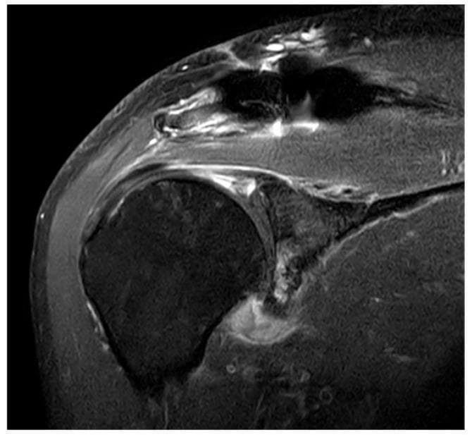 This diagnostic image is a coronal T2-weighted fat-suppressed MRI of the right shoulder joint. The primary finding is a significantly thickened glenohumeral joint capsule demonstrating increased signal intensity, most prominent at the axillary capsular pouch. These findings are characteristic of adhesive capsulitis (frozen shoulder), indicating inflammatory changes and edema within the joint capsule. The image clearly shows the relationship between the humeral head, glenoid, and the inferior redundant fold of the capsule (axillary pouch). The surrounding soft tissues, including the deltoid muscle and subacromial space, are visible with high contrast. The increased signal intensity within the inferior capsule suggests active inflammation or synovitis, which is a hallmark finding in patients presenting with painful shoulder stiffness. The MRI provides sufficient resolution to distinguish these pathological capsular changes from normal thin, low-signal ligamentous structures.