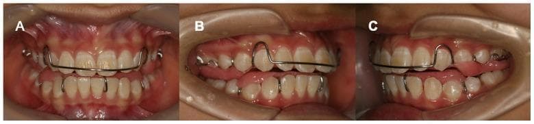 Clinical intraoral photographs displaying a Twin-Block (TB) functional orthodontic appliance in a pediatric or adolescent patient. The image is divided into three views: frontal (A), right lateral (B), and left lateral (C). The appliance consists of upper and lower removable components featuring pink acrylic bases adapted to the palate and mandibular lingual surfaces. The maxillary component includes a labial bow—a horizontal metal wire spanning the incisors—and bilateral Adam's clasps for molar retention. The lateral views (B and C) demonstrate the characteristic interdigitation of the maxillary and mandibular acrylic blocks, designed to reposition the mandible anteriorly to correct Class II malocclusion. Retractors are used to provide clear visualization of the dental arches, gingival margins, and the appliance's fit. The teeth exhibit an off-white coloration with visible metal stabilization wires. This content is intended for orthodontic education regarding functional appliance therapy and myofunctional treatment of skeletal discrepancies.