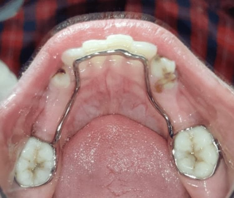This clinical photograph shows a post-operative intraoral occlusal view of the mandible in a pediatric patient. The primary feature is a 3D-printed lingual arch space maintainer fabricated from a titanium-based powdered metal. The appliance is a monolithic, one-piece design consisting of bilateral molar bands cemented onto the permanent first molars, connected by a rigid metal arch wire that follows the lingual contour of the mandibular dentition. The arch wire is positioned to maintain the mesiodistal dimensions of the arch following the extraction of primary molars (indicated by edentulous spaces in the premolar regions). Adjacent teeth, specifically the canines and primary molars, exhibit visible dental pathology, including brown carious lesions and structural loss on the facial and occlusal surfaces. The image demonstrates the application of additive manufacturing (micro laser sintering) in pediatric dentistry to provide a customized, well-adapted orthodontic appliance that minimizes occlusal interference and potential breakage points common in traditional soldered appliances.