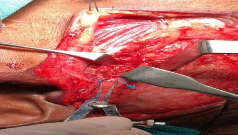 This clinical photograph illustrates an intraoperative view of an open parotidectomy surgical field. The image highlights the identification and measurement of surgical landmarks within the parotid bed. Castroviejo calipers are utilized to measure the shortest distance between the tragal pointer (TP), indicated by blue dotted lines, and the main trunk of the facial nerve (FN), denoted by a blue arrow. The surgical field displays exposed soft tissues, including the posterior belly of the digastric muscle and the sternocleidomastoid muscle, following glandular resection. Self-retaining or manual retractors are visible, providing exposure of the deep neck anatomy and the facial nerve's exit from the stylomastoid foramen. This visual demonstrates critical surgical steps in head and neck surgery, emphasizing the importance of anatomical landmarks for the preservation of the facial nerve during parotid gland procedures. The clinical focus is on surgical anatomy, nerve monitoring, and precise measurement for surgical outcomes.