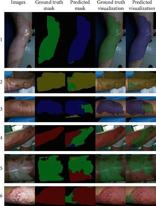 This clinical image comparison displays a series of six burn injury samples (labeled 1-6) analyzed via a deep learning segmentation network for burn depth classification. Each sample is presented in five columns: the original clinical photograph, ground truth mask, predicted mask, ground truth visualization (overlay), and predicted visualization (overlay). The images depict various anatomical regions, including limbs and torso. The segmentation uses a specific color-coding scheme: Blue represents superficial partial-thickness burns; Green indicates deep partial-thickness burns; Red denotes full-thickness burns; and Yellow signifies undebrided burn areas. Visually, superficial partial-thickness areas show mild erythema, whereas deep partial-thickness and full-thickness burns exhibit more extensive tissue damage, altered texture, and significant color variations from pale white to deep red. The figure serves as an educational tool for diagnostic radiology and dermatology, demonstrating the ability of AI to differentiate between complex burn severities and the challenges of accurately delineating transition zones between different burn depths.