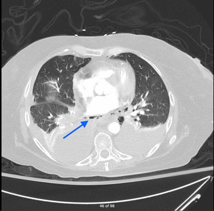 An axial view from a CT angiography (CTA) of the chest demonstrating pneumomediastinum and associated thoracic pathology. A blue arrow highlights extraluminal air pockets (pneumomediastinum) located in the posterior mediastinum, adjacent to the distal esophagus. The right lung displays increased opacity and hazy consolidation, particularly in the perihilar region, consistent with atelectasis or underlying infection. Bilateral pleural abnormalities are noted, with a visible right-sided pleural effusion and possible thickening of the pleural margins. The central vascular structures, including the aorta and heart, are visible with contrast enhancement. This clinical imaging finding is highly indicative of esophageal perforation (Boerhaave syndrome or traumatic injury) necessitating urgent evaluation. The image serves as an educational resource for identifying mediastinal air collections and secondary pulmonary manifestations of esophageal rupture.