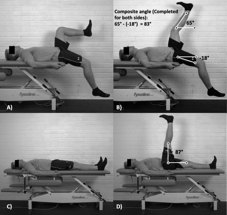 This clinical photograph set demonstrates two physical examination methods for assessing lower limb range of motion (ROM) and lumbopelvic flexibility. Panels A and B illustrate the 'Jurdan test,' a composite measurement combining aspects of the active knee extension test and the modified Thomas test. The subject is supine on an examination plinth with the testing leg elevated and the knee extended, while the contralateral leg is positioned at the edge of the table to assess hip extension. Panel B displays the calculation of a 'composite angle' (83 degrees) derived from the active knee extension angle (65 degrees) and the contralateral passive hip flexion angle (-18 degrees). Panels C and D demonstrate the Active Straight Leg Raise (ASLR) test, where the subject is supine with one leg actively flexed at the hip while keeping the knee straight. Panel D shows an ASLR angle of 87 degrees. These tests are utilized in sports medicine and physical therapy to evaluate hamstring extensibility, iliopsoas flexibility, and limb asymmetry, particularly in the context of hamstring strain injury risk assessment and sprinting kinematics.