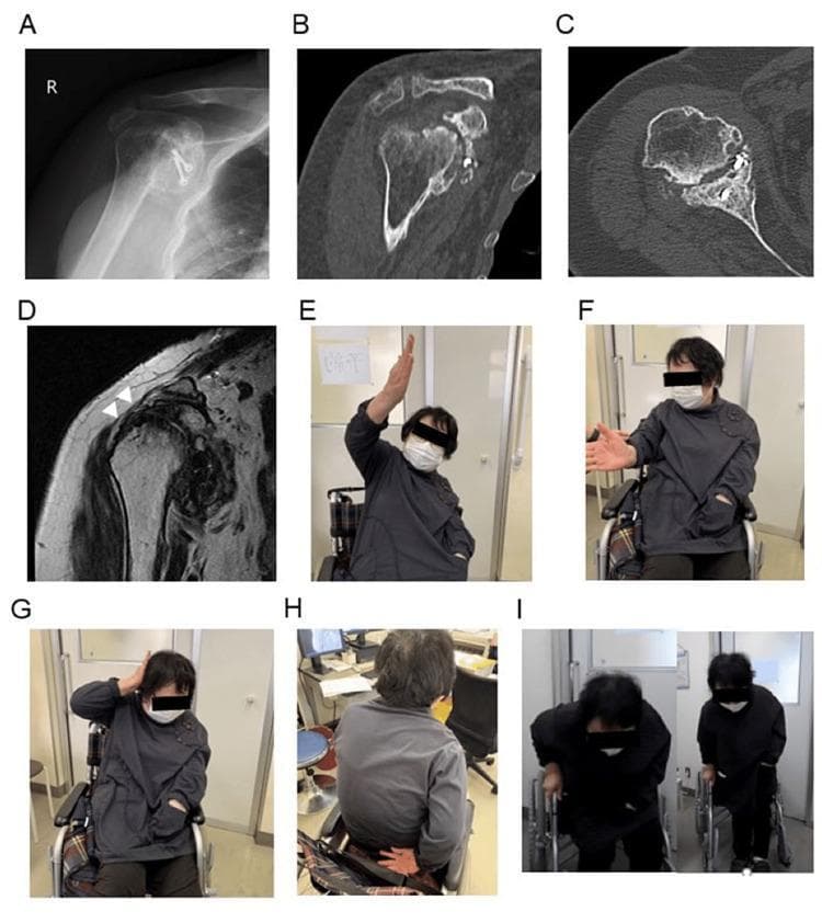 This composite figure illustrates the 50-month post-operative outcomes of a patient following a Latarjet procedure for recurrent shoulder dislocation. Panels A-D display multi-modal diagnostic imaging of the right shoulder: (A) An anteroposterior radiograph showing glenohumeral osteoarthritis and surgical hardware; (B-C) Sagittal and axial CT scans demonstrating successful coracoid bone graft transfer and integration into the anterior glenoid rim; (D) A coronal T2-weighted MRI where white arrowheads indicate the structural integrity of the repaired supraspinatus tendon. Panels E-I are clinical photographs assessing functional recovery and active range of motion: (E) Shoulder flexion reaching 120 degrees; (F) External rotation to 30 degrees; (G) Functional ability to reach the hand behind the head with the elbow back; (H) Internal rotation to the level of the fifth lumbar spine; and (I) The patient demonstrating weight-bearing capability by standing independently from a wheelchair. The collection serves as an educational example of managing complex shoulder instability through bone block reconstruction and rotator cuff repair in a patient with hemiplegia.