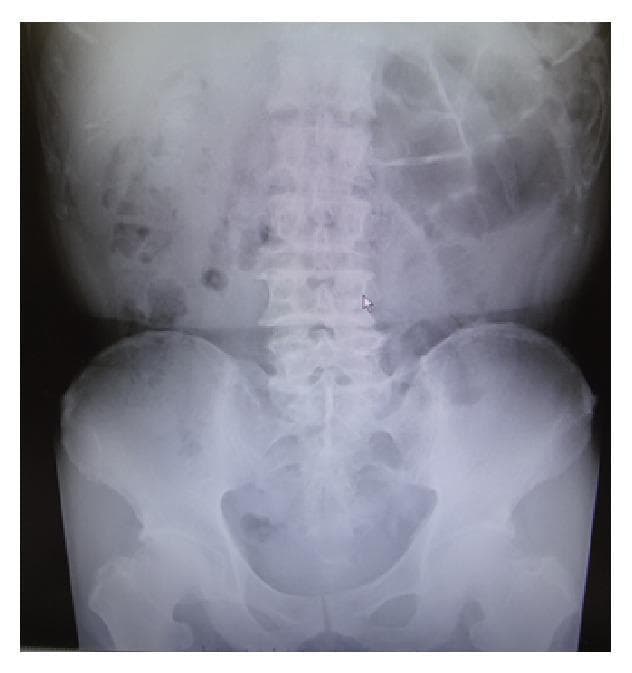 This diagnostic image is an upright abdominal radiograph (X-ray) of an adult patient. The primary finding is the presence of multiple dilated loops of small bowel, most prominently clustered in the upper-left and middle abdominal quadrants. Clear air-fluid levels are visible within these dilated segments, a characteristic sign of bowel obstruction. The valvulae conniventes are identifiable across the lumen of the dilated loops, supporting the classification as small bowel rather than large bowel. No obvious free air is seen under the diaphragm, suggesting the absence of gastrointestinal perforation. The lumbar spine and pelvic girdle are visible and serve as anatomical landmarks. This image illustrates key radiological features of a mechanical small bowel obstruction, which clinically in this case was secondary to an internal hernia through a mesenteric defect.