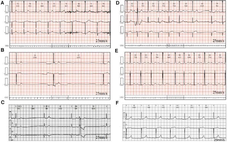 This diagnostic image consists of six 3-lead electrocardiogram (ECG) rhythm strips, labeled A through F, recorded at a paper speed of 25 mm/s. The series demonstrates the progression and resolution of drug-induced cardiac conduction disturbances in a patient. Strip A shows tachycardia with second-degree atrioventricular (AV) block Mobitz Type I (Wenckebach). Strip B illustrates severe sinus bradycardia and sinus arrest with a prolonged R-R interval. Strip C reveals persistent sinus arrest and first-degree AV block. Strip D displays a return to a more regular rhythm but with continued evidence of prolonged PR intervals and Mobitz Type I conduction patterns. Strip E shows intermittent first-degree AV block with improved heart rate during medical management. Finally, Strip F demonstrates a stable sinus rhythm with a residual first-degree AV block after the discontinuation of the suspected causative medication (escitalopram). These strips collectively highlight various arrhythmias including sinus node dysfunction, AV conduction delays, and rhythm changes associated with pharmacotherapy monitoring.