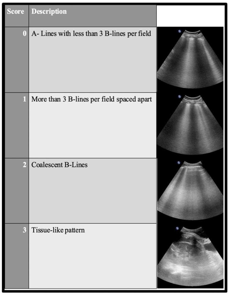 This diagnostic comparison chart illustrates the Lung Ultrasound (LUS) scoring system used to quantify the loss of lung aeration, particularly in critical care and COVID-19 settings. The chart is organized into four levels of increasing severity from Score 0 to 3. Score 0 (Normal) depicts horizontal A-lines with fewer than three vertical B-lines, indicating normal aeration. Score 1 (Moderate Aeration Loss) shows more than three B-lines per intercostal field, which remain distinct and spaced apart. Score 2 (Severe Aeration Loss) demonstrates coalescent B-lines that merge together, creating a 'white lung' appearance. Score 3 (Complete Aeration Loss) shows a tissue-like pattern, representing lung consolidation where the organ resembles solid parenchyma (hepatization). Each score is accompanied by a representative B-mode ultrasound image obtained using a convex probe, showing the transition from reverberation artifacts to structural visualization. This tool is essential for point-of-care ultrasound (POCUS) assessment of interstitial syndrome and pneumonia progression.