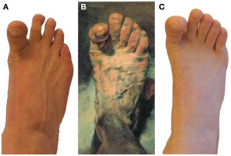 This composite educational graphic presents a comparison between clinical photography and art history to illustrate neurological signs. Panel A shows a clinical photograph of a human foot with a clearly extended (dorsiflexed) hallux (great toe) and slightly flexed lesser toes, a posture characteristic of the Babinski sign or voluntary extension. Panel B features a realistic painting, 'The Painter’s Foot' by Adolph von Menzel, depicting a foot with a similarly isolated extension of the great toe, used here to discuss the historical representation of potential neurological pathology versus anatomical realism. Panel C provides a comparative clinical photograph of a foot in a relaxed anatomical position with neutral toe alignment. The collection serves to teach medical students and neurology residents how to visually identify the extensor plantar response (Babinski sign), a key indicator of upper motor neuron dysfunction, and explores the diagnostic intersection between clinical observation and anatomical art.